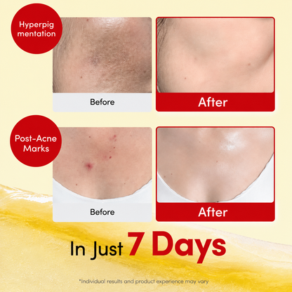 Erase Years of Dark Spots From Your Face and Body